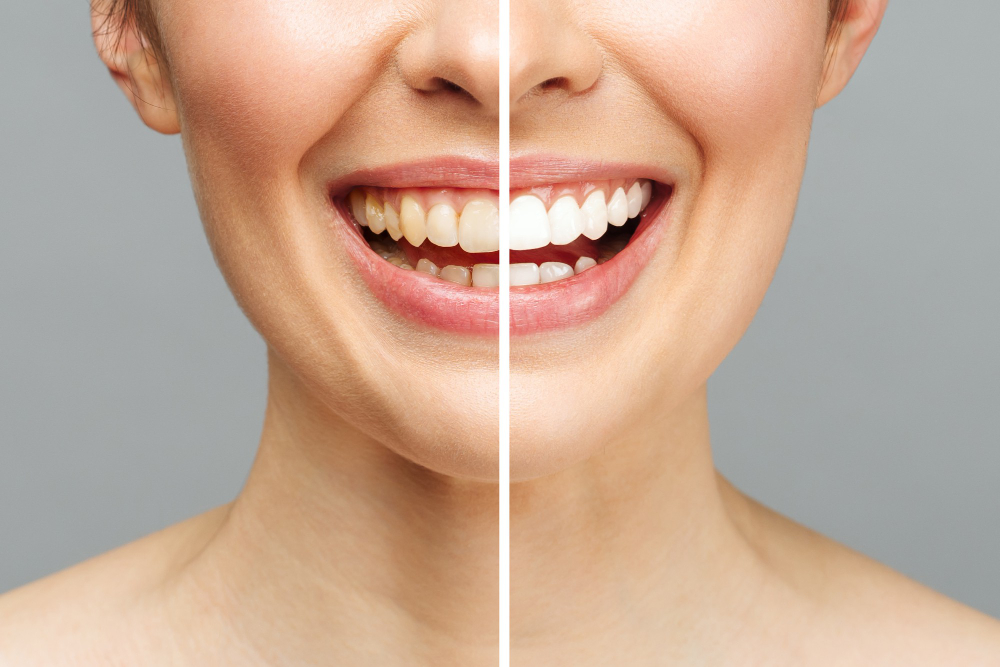 Teeth Whitening